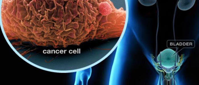 bladder cancer treatment